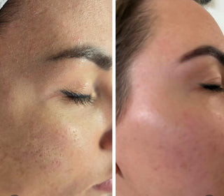 Growth Factors and Microchanneling- the key to barrier supported Glowing Skin